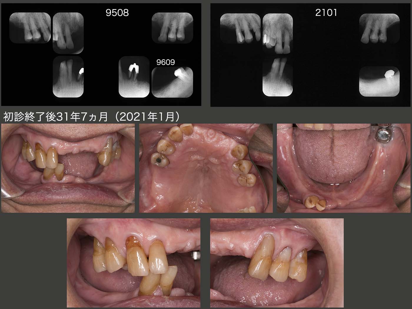 21.パーシャルデンチャー31年7ヵ月経過症例 | 古屋歯科クリニック症例集